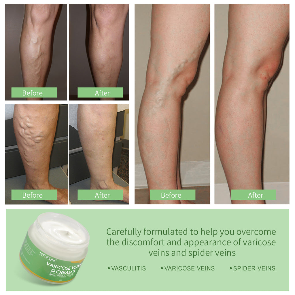 Varicose Vein Relief Cream - Beauty & Skincare | TARVIX Varicose Vein Relief Cream